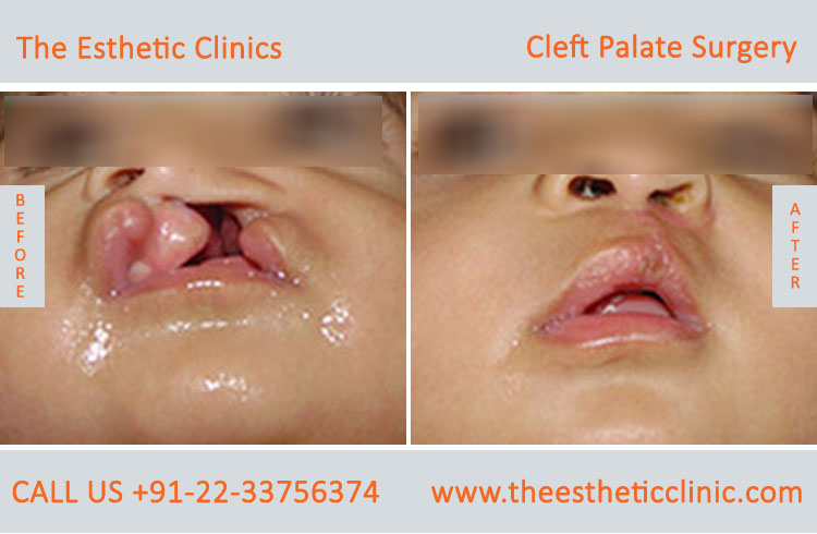 cleft palate surgery, Cleft Palate Repair Treatment before after photos in mumbai india (3)